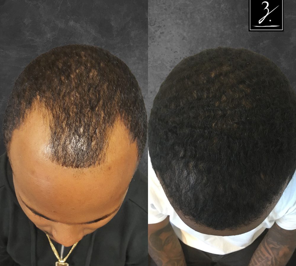 Image showing a before-and-after comparison of a hair restoration treatment. The left side displays a receding hairline with thinning hair, while the right side shows a fuller, healthier hair appearance after the treatment. The image highlights the effectiveness of hair restoration techniques, emphasizing the transformation in hair density and coverage. Ideal for individuals considering hair loss solutions.