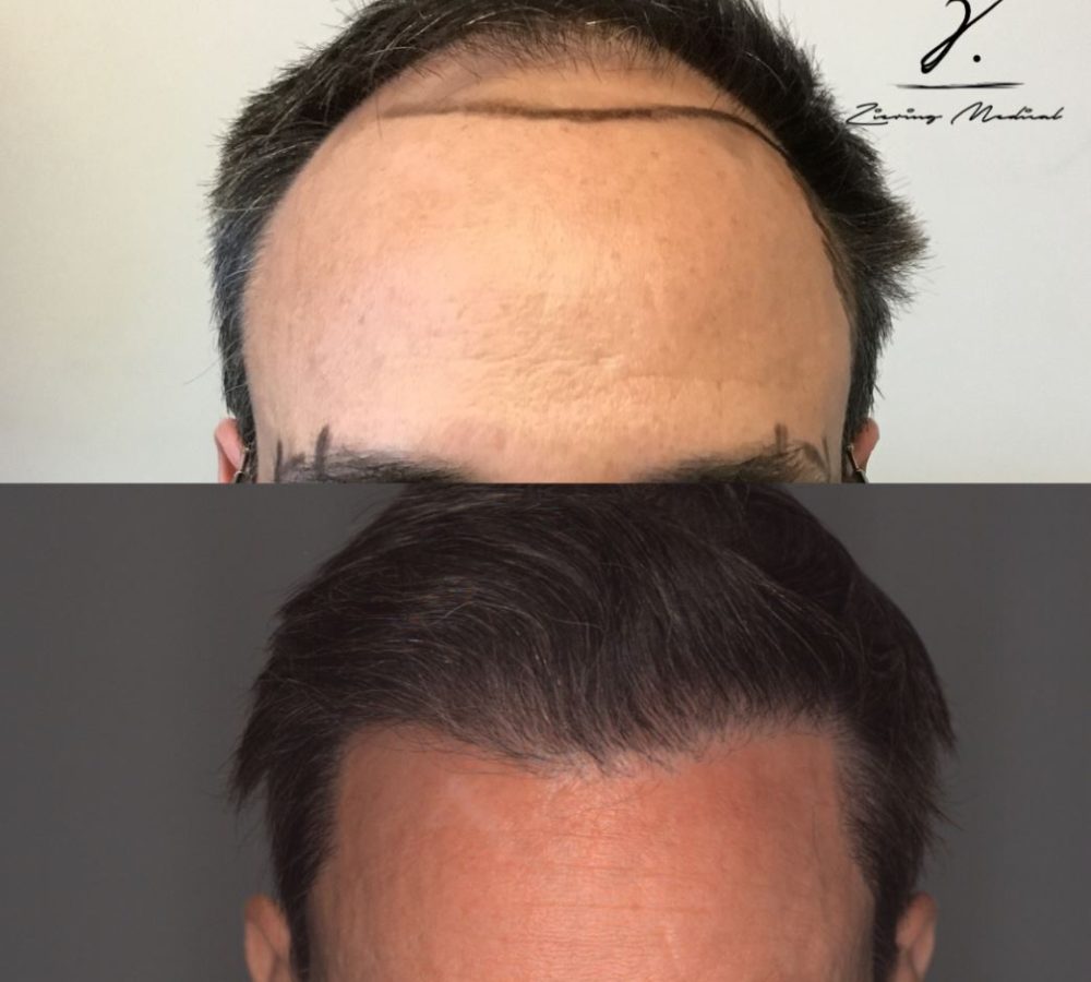 Before and after image showcasing a hair restoration procedure. The top half displays a receding hairline with visible thinning, while the bottom half illustrates a fuller and more natural-looking hairline post-treatment. The transformation highlights the effectiveness of modern hair restoration techniques, providing a solution for individuals experiencing hair loss. This image serves as a visual representation of the potential results from hair transplant surgery, emphasizing improved hair density and style. Ideal for those seeking information on hair restoration options.