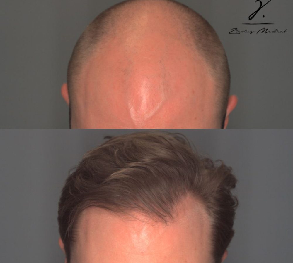 Before and after images showcasing hair restoration results. The top image displays a bald scalp with visible hair loss, while the bottom image features a full head of hair, demonstrating effective hair regrowth. This visual representation highlights the transformative effects of hair restoration treatments, appealing to individuals seeking solutions for hair thinning or baldness. Ideal for those researching hair restoration options, this image emphasizes the potential for a natural-looking hairline and improved confidence.